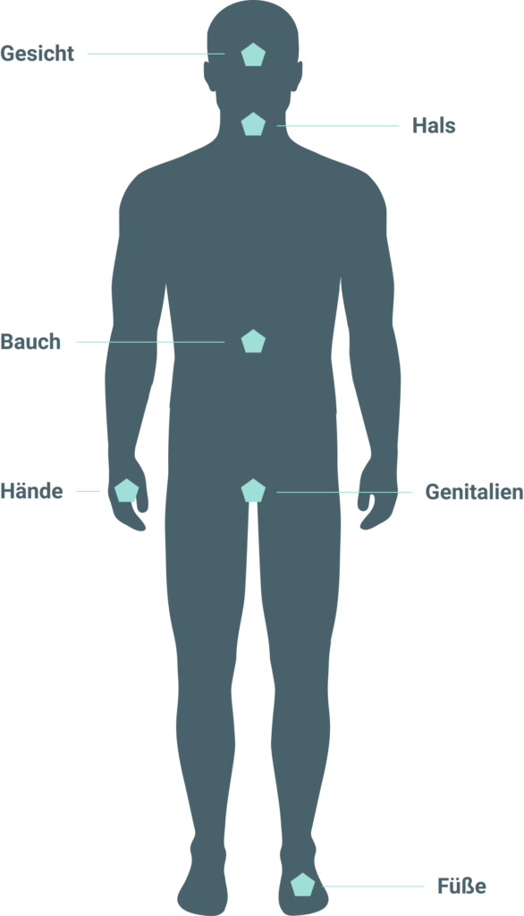 Darstellung menschlicher Körper mit betroffenen HAE-Bereichen